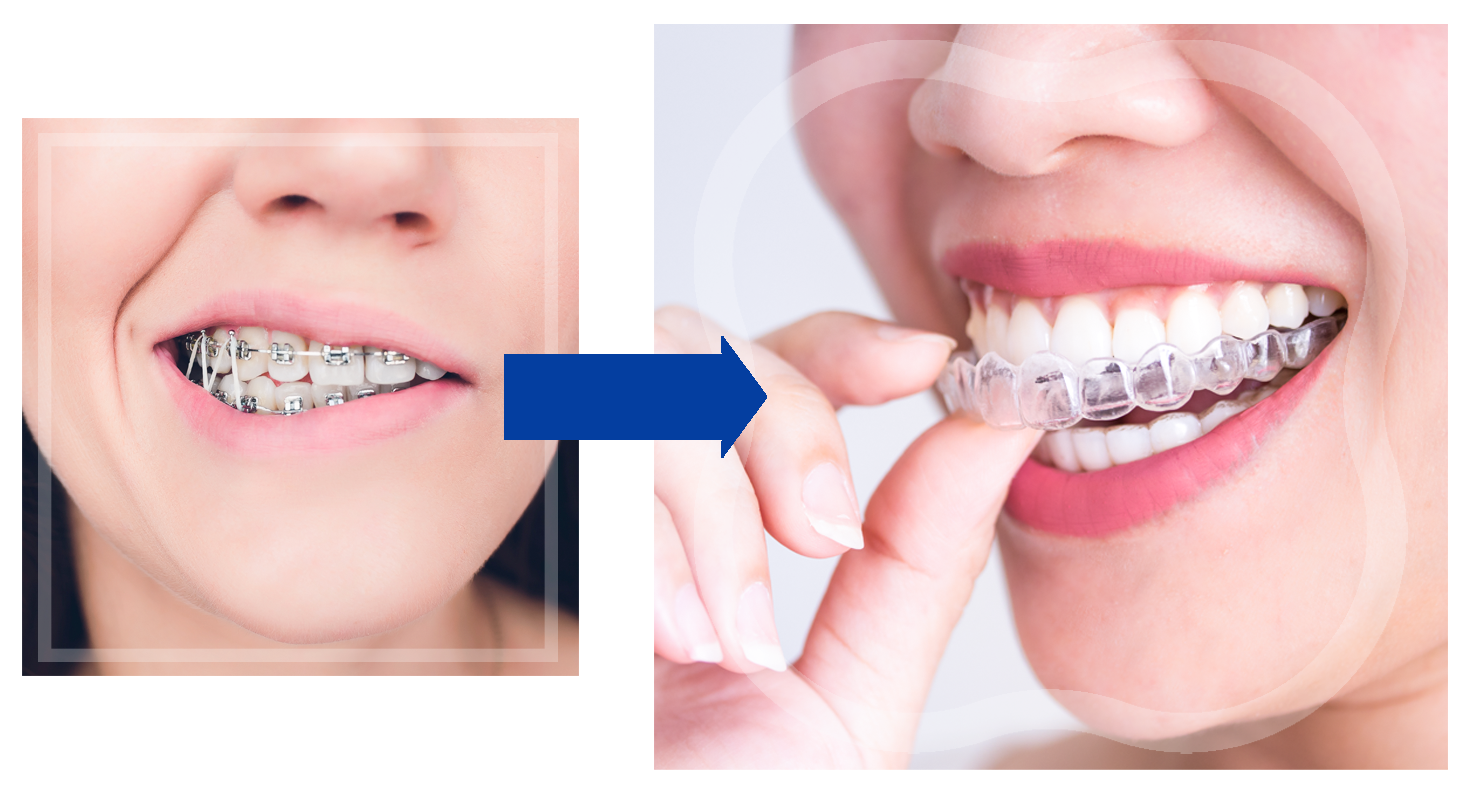 braces vs orthosnap
